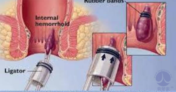 最新痔疮治疗方法概览