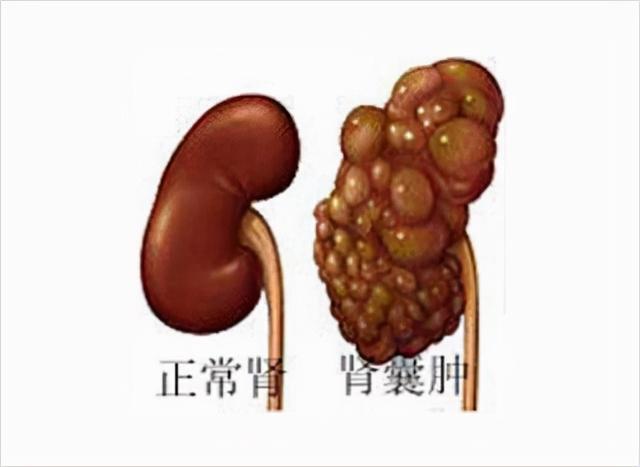 肾囊肿最新治疗进展研究及进展概述